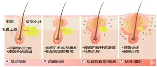 痤瘡發(fā)生機制